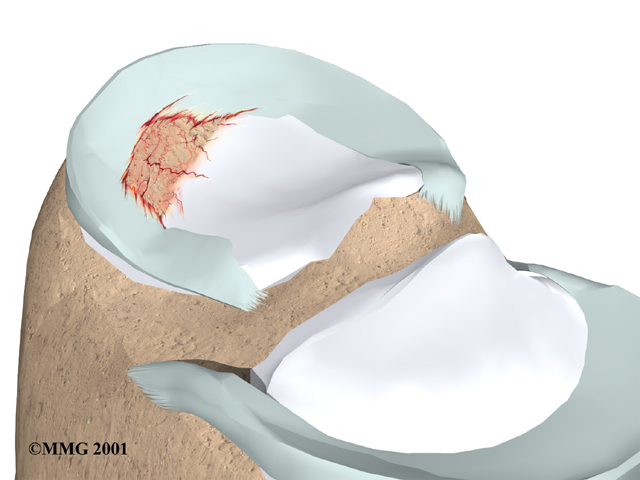 Anatomy of the meniscus and an example of a meniscus tear
