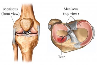 Example of meniscus tear