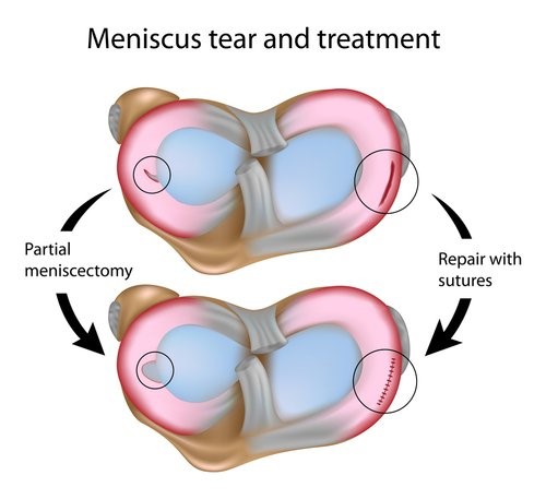 Two treatments for mensicus tears