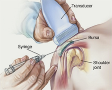 Ultrasound-guided shoulder injection showing a transducer and syringe targeting the bursa and shoulder joint for pain relief