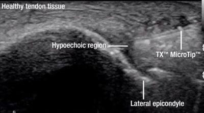 Ultrasound image of the elbow showing healthy tendon tissue, a hypoechoic region, lateral epicondyle, and TX MicroTip used fo